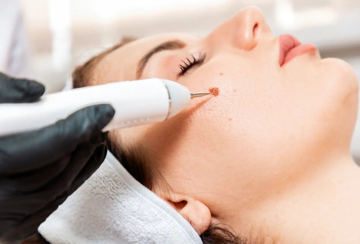 Frequently Asked Questions About Multiple Cryotherapy Treatments Staines
