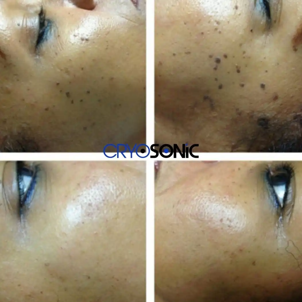 Why Skin Shows Pigmentation After Treatment Staines