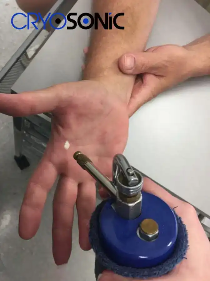 Temperature Differences: OTC vs Medical-Grade Cryotherapy Staines